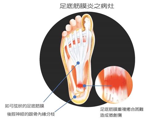 吱腳板底|腳底板痛是足底筋膜炎？腳底痛原因、位置、舒緩一次。